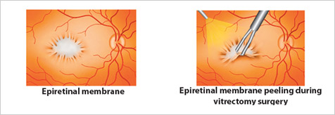 vitrectomy membrane peeling