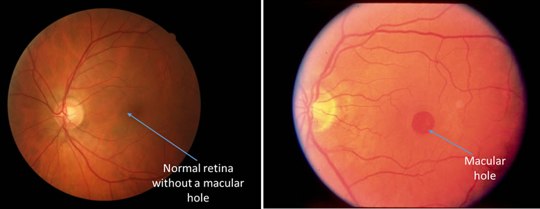 hole in retina and cancer meds