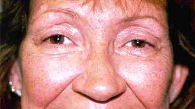 Adult after eye muscle surgery image