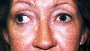 Before And After Eye Muscle Surgery Photos | Sarasota, Bradenton, Florida