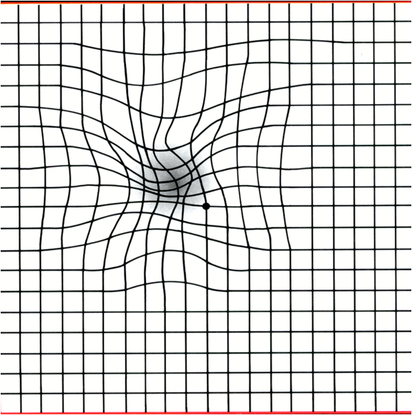 Amsler macular degeneration image