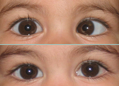 Before and after eye muscle surgery image