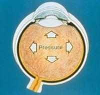 Glaucoma illustration image