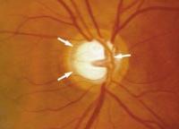Common glaucoma eye disc image