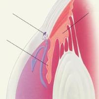 Common glaucoma image