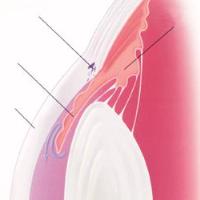 Common glaucoma image