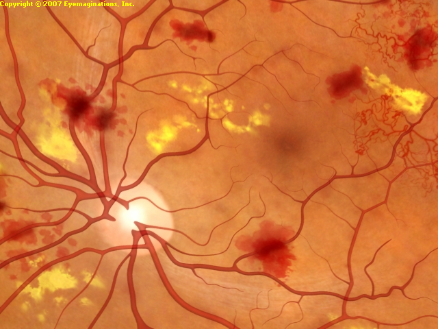 Diabetic retina image
