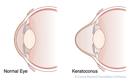 Keratoconus slide image
