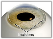 Illustration of where incisions are made for advanced lens implants image