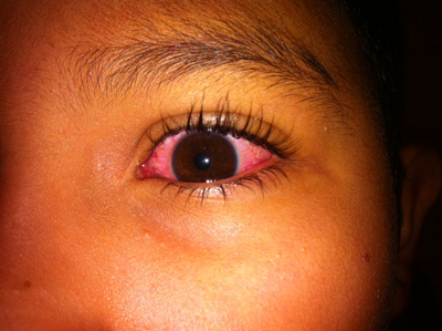 Child with pink eye image