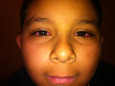 Child with pink eye image