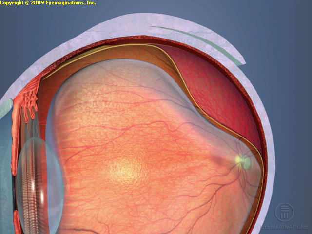 Retinal detachment Illustration