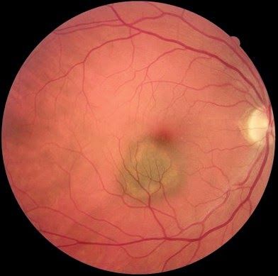 Eye with Choroidal Nevus image