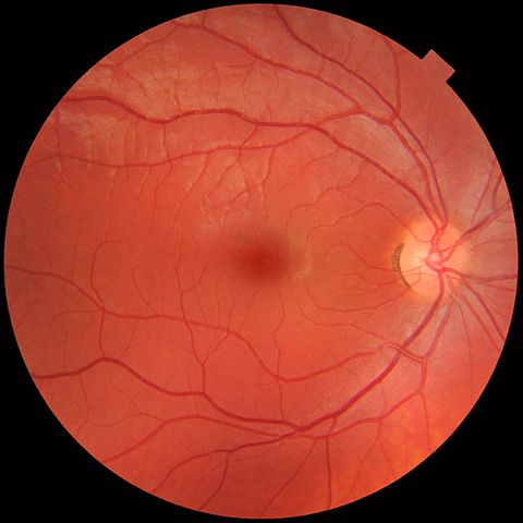 Choroidal Nevus (Freckle) - Coastal Eye